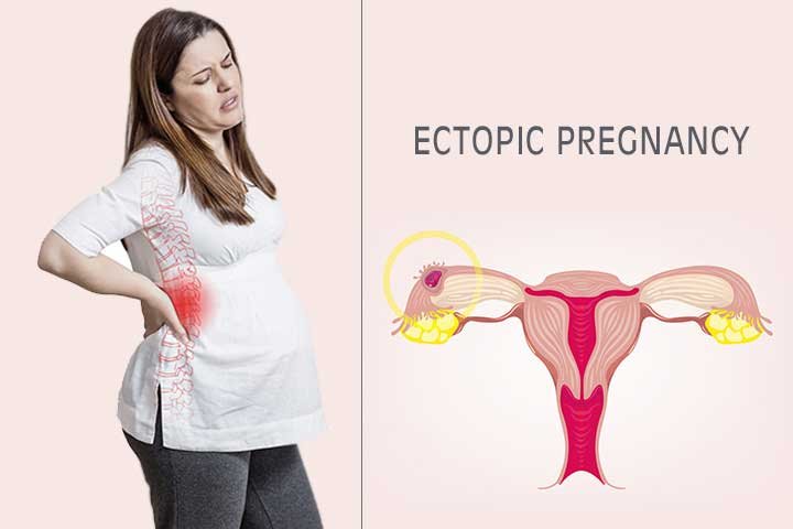 Symptoms of ectopic pregnancy