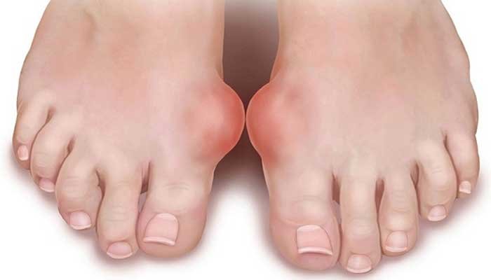 Symptoms of gout